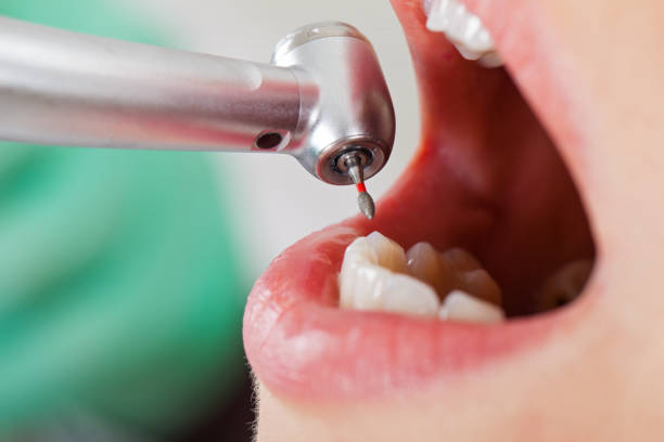 Best Emergency Root Canal Therapy in Morristown, NJ